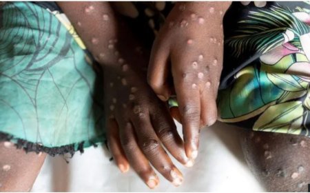 Uganda: Umubare w'abibasirwa na Mpox ukomeje gutumbagira