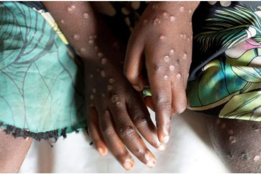Uganda: Umubare w'abibasirwa na Mpox ukomeje gutumbagira