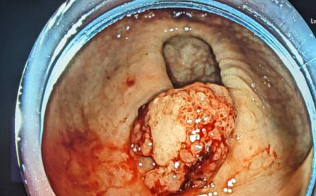 Ku nshuro ya mbere abaganga bo mu Rwanda bakuye igice gifite kanseri mu mubiri w’umuntu batamubaze